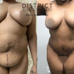 abdominoplasty before and after