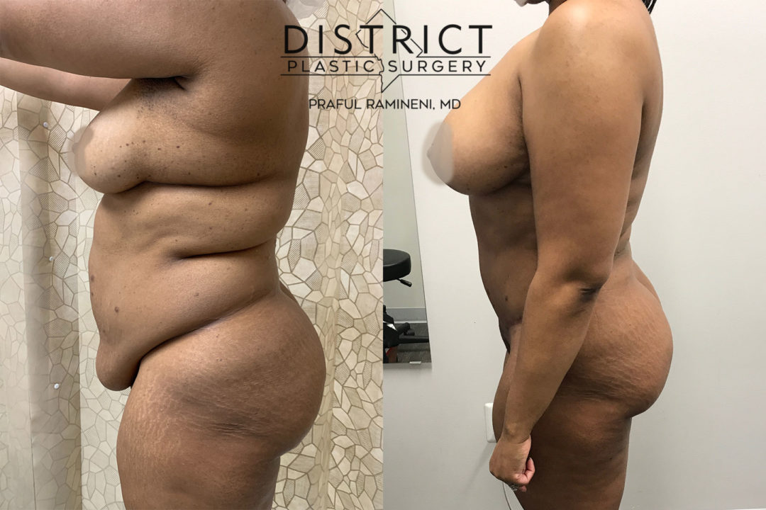 abdominoplasty before and after