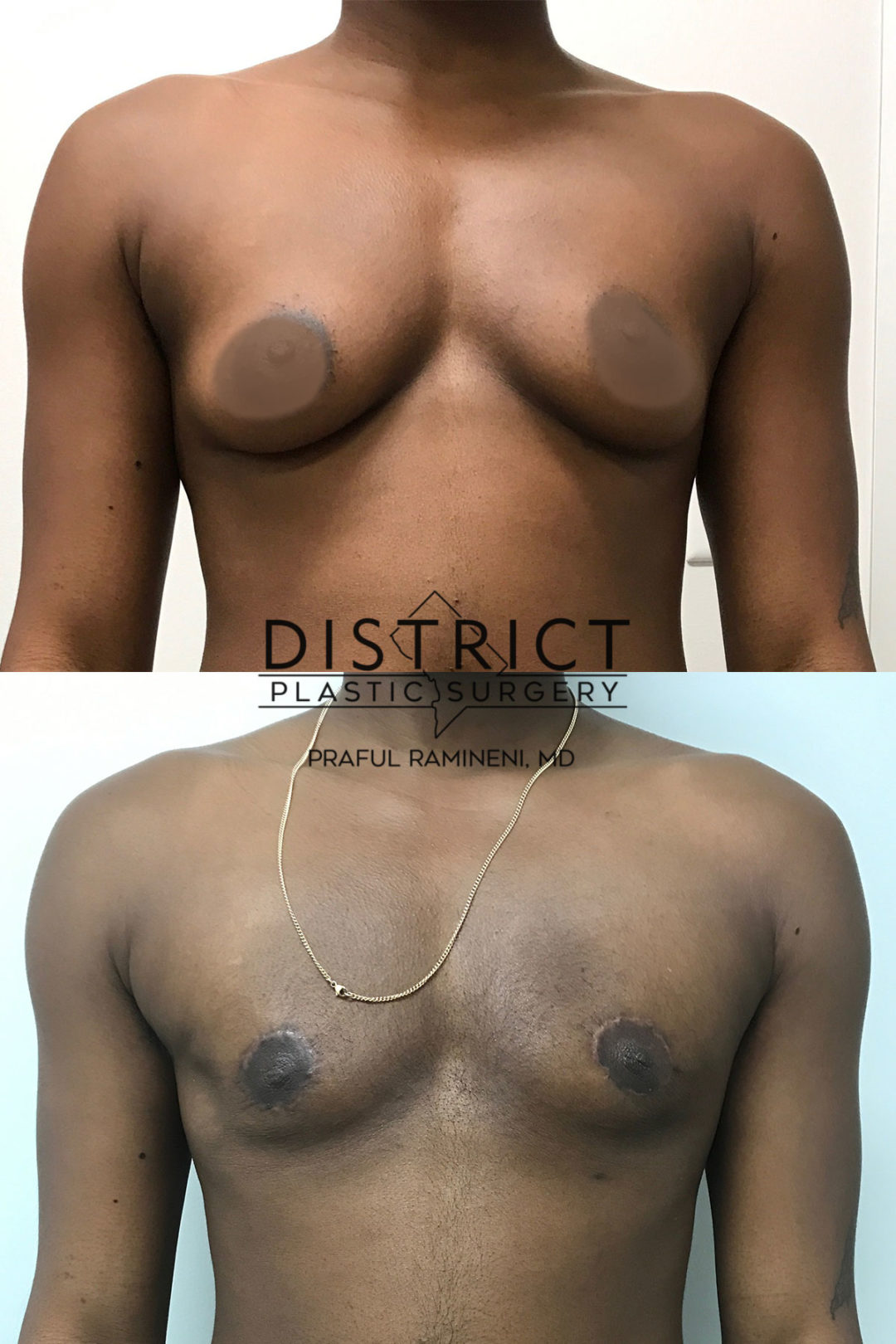 peri areolar mastectomy before and after