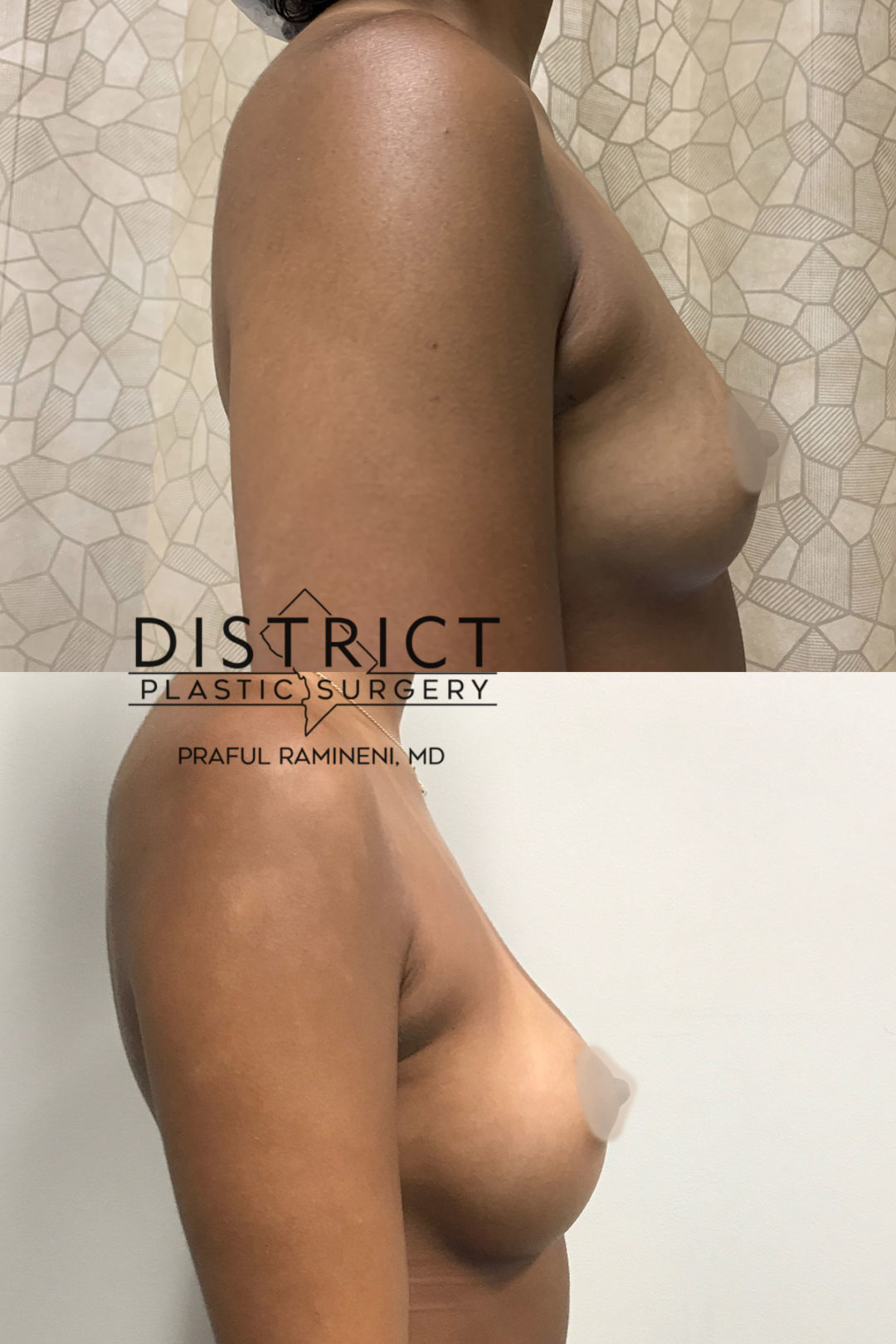 breast augmentation before and after