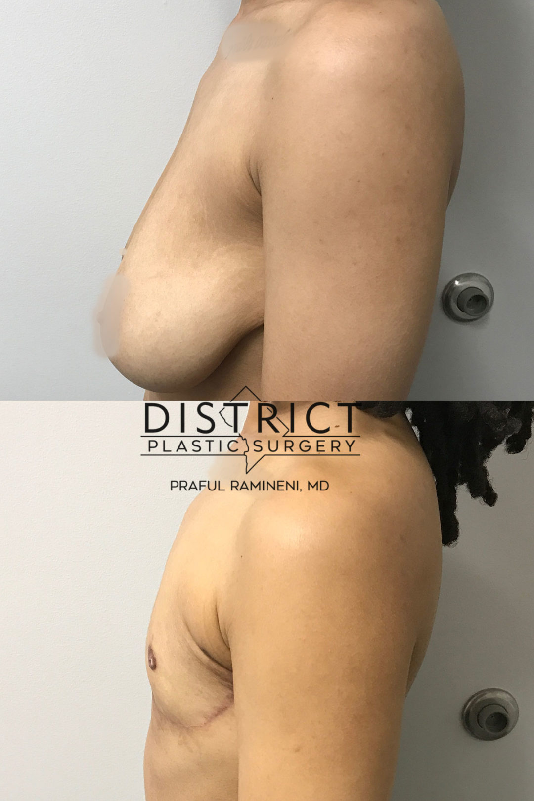 double incision mastectomy before and after
