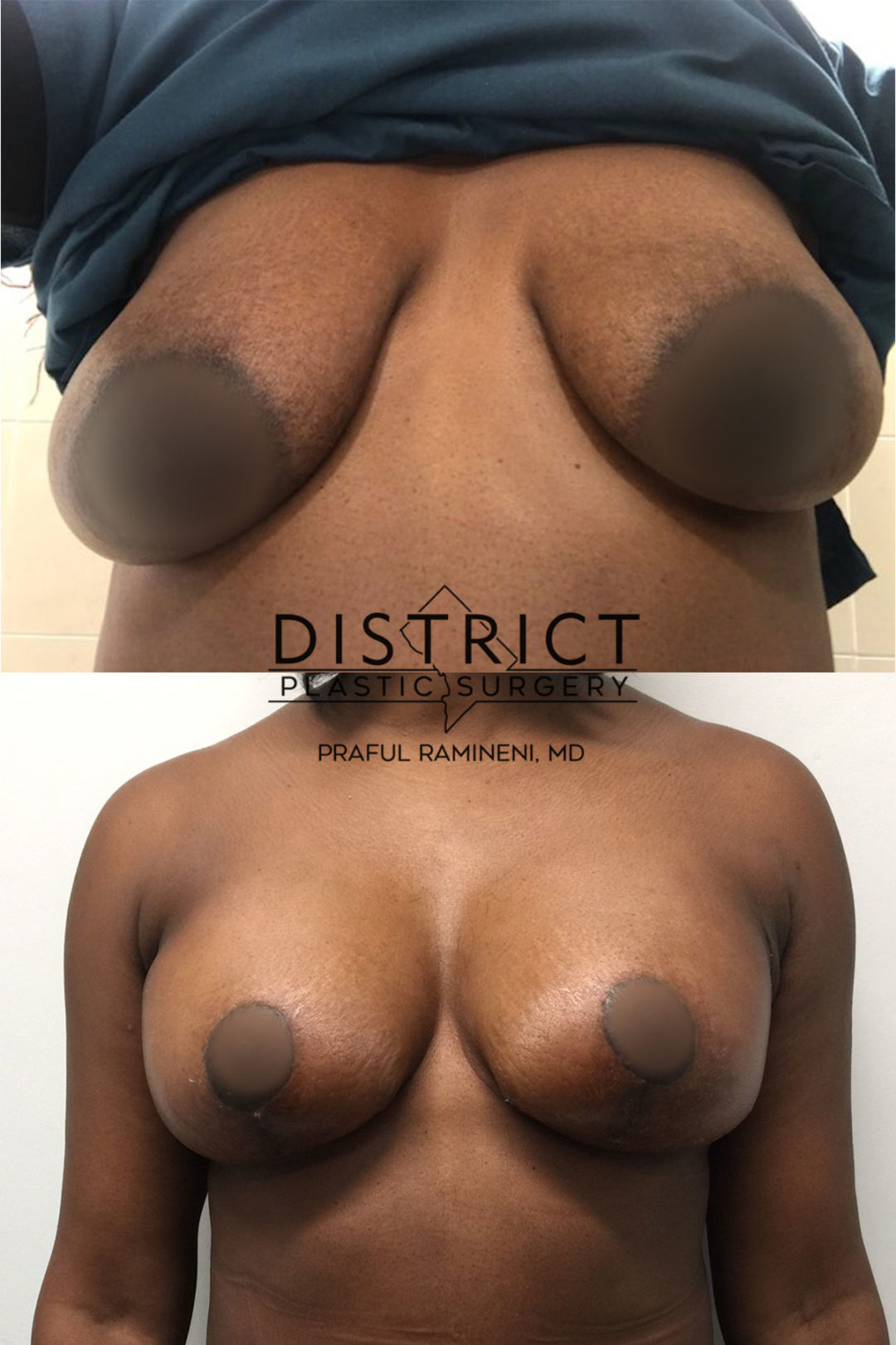 breast lift before and after