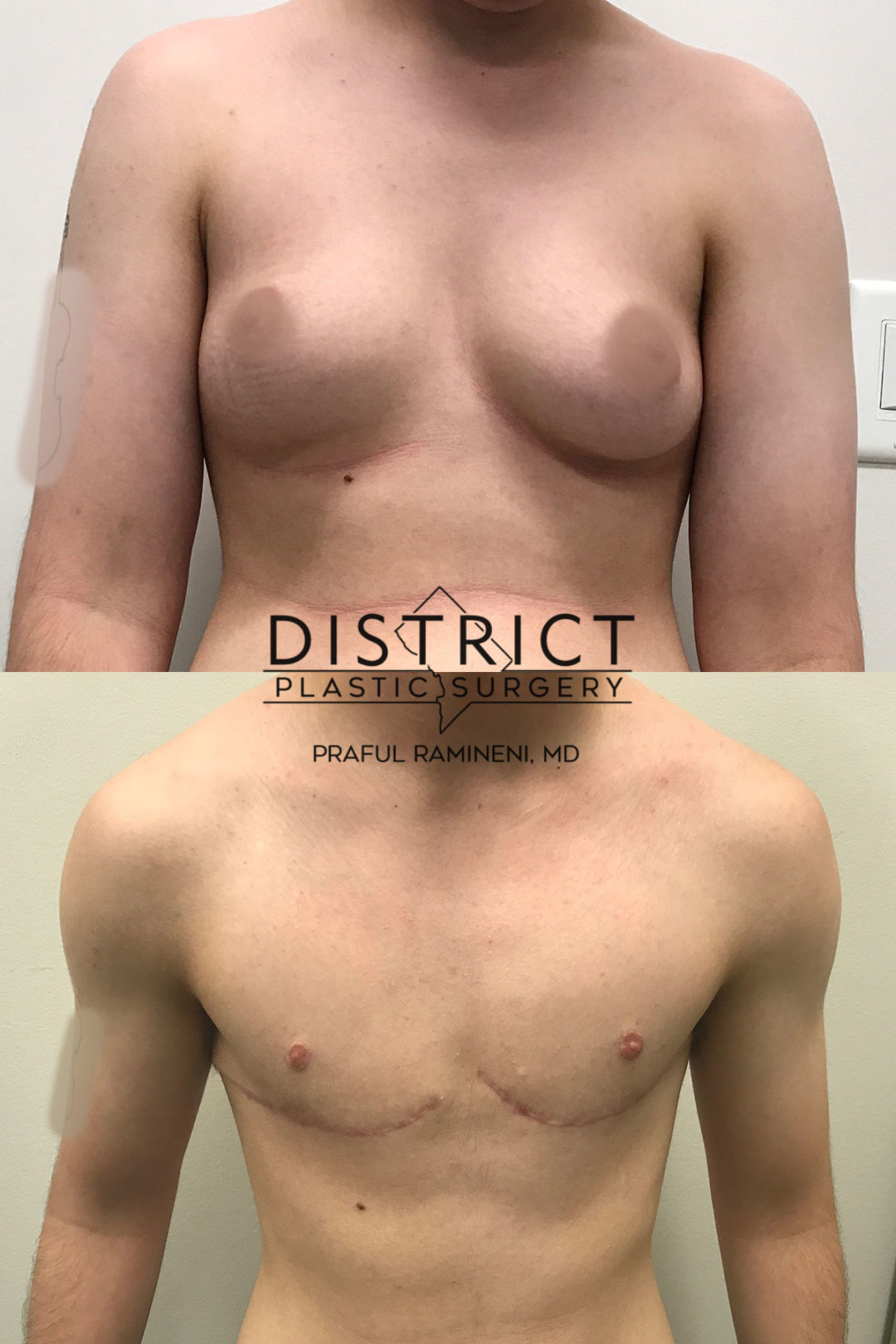 Double Incision Mastectomy Before and After Photo by District Plastic Surgery in Washington, DC