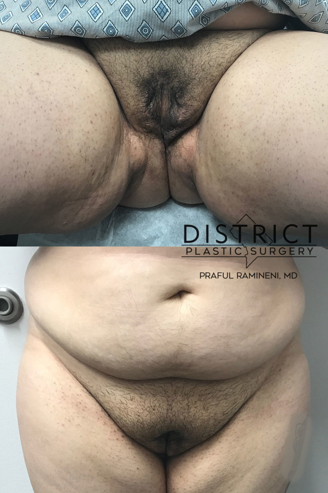 vaginoplasty before and after