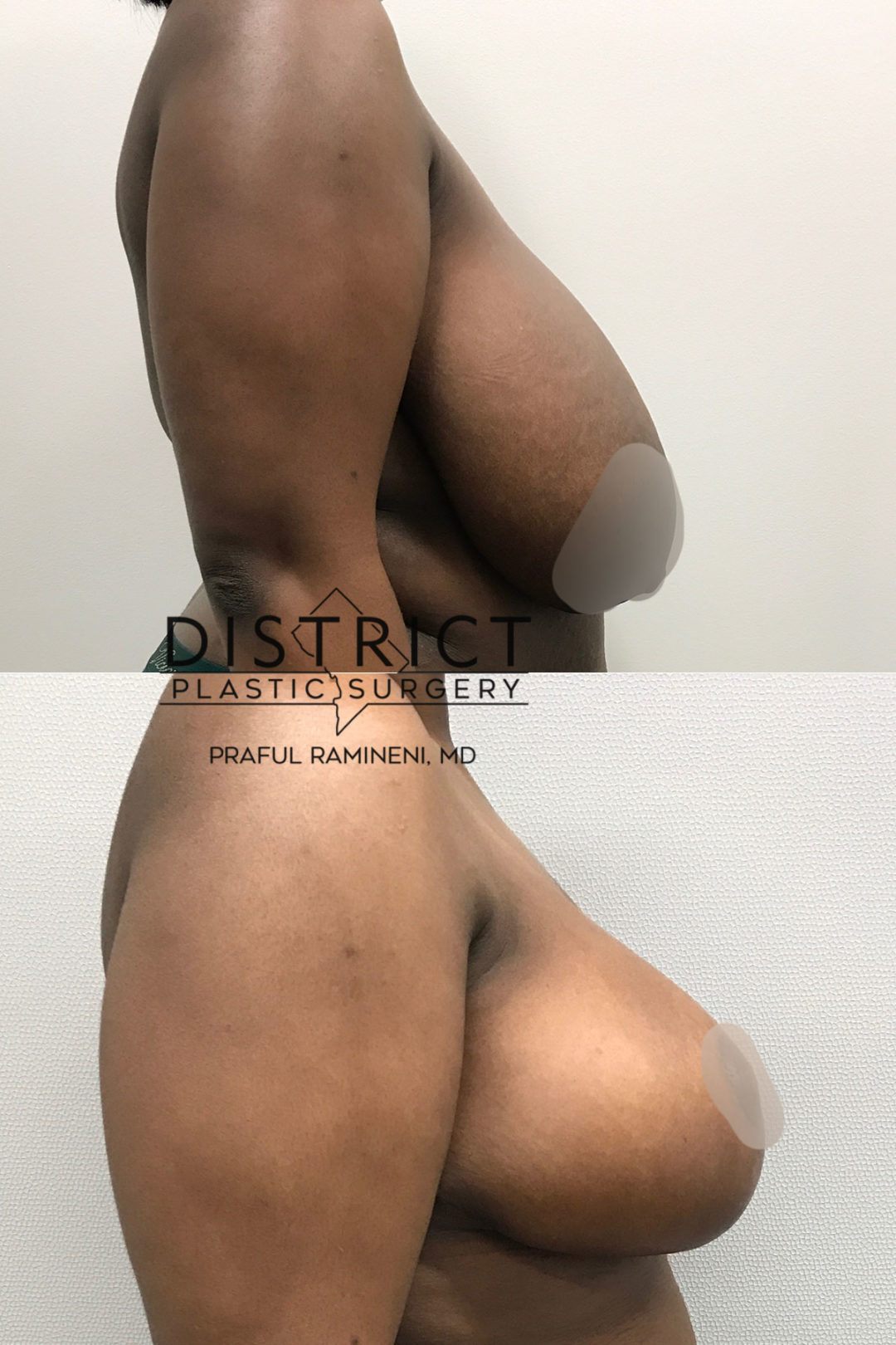 breast reduction before and after