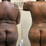 brazillian butt lift before and after