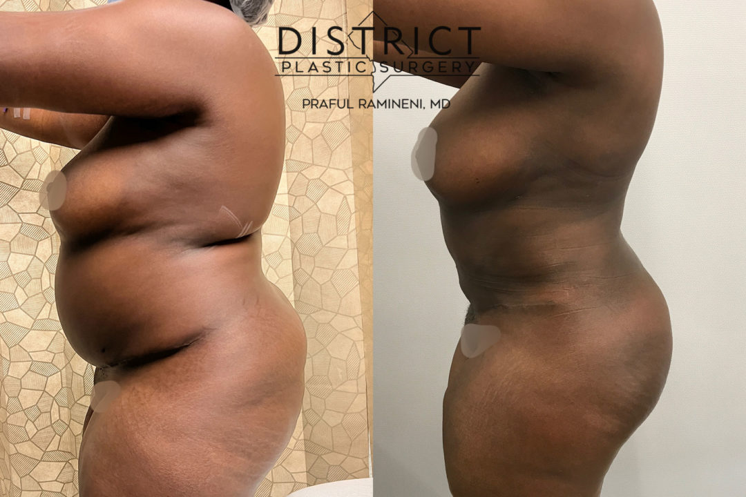 brazillian butt lift before and after