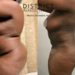 brazillian butt lift before and after