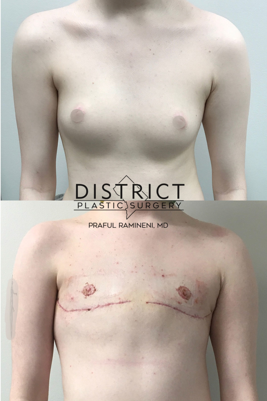 Double Incision Mastectomy Before and After Photo by District Plastic Surgery in Washington, DC