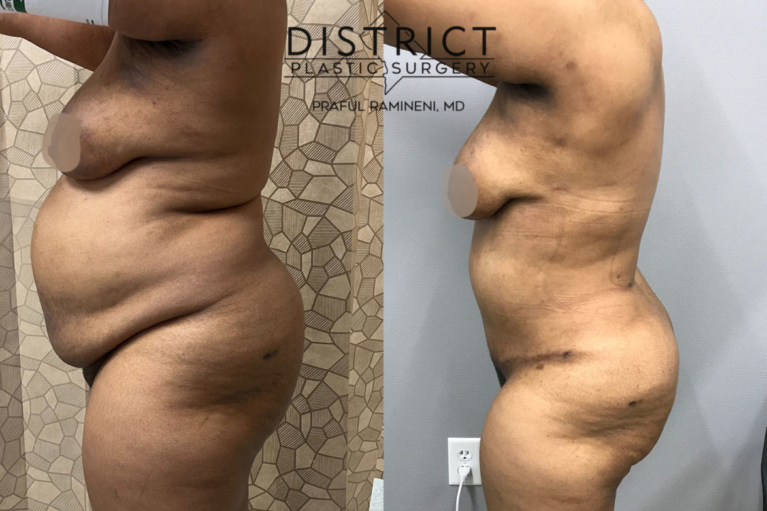 abdominoplasty before and after