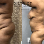 abdominoplasty before and after