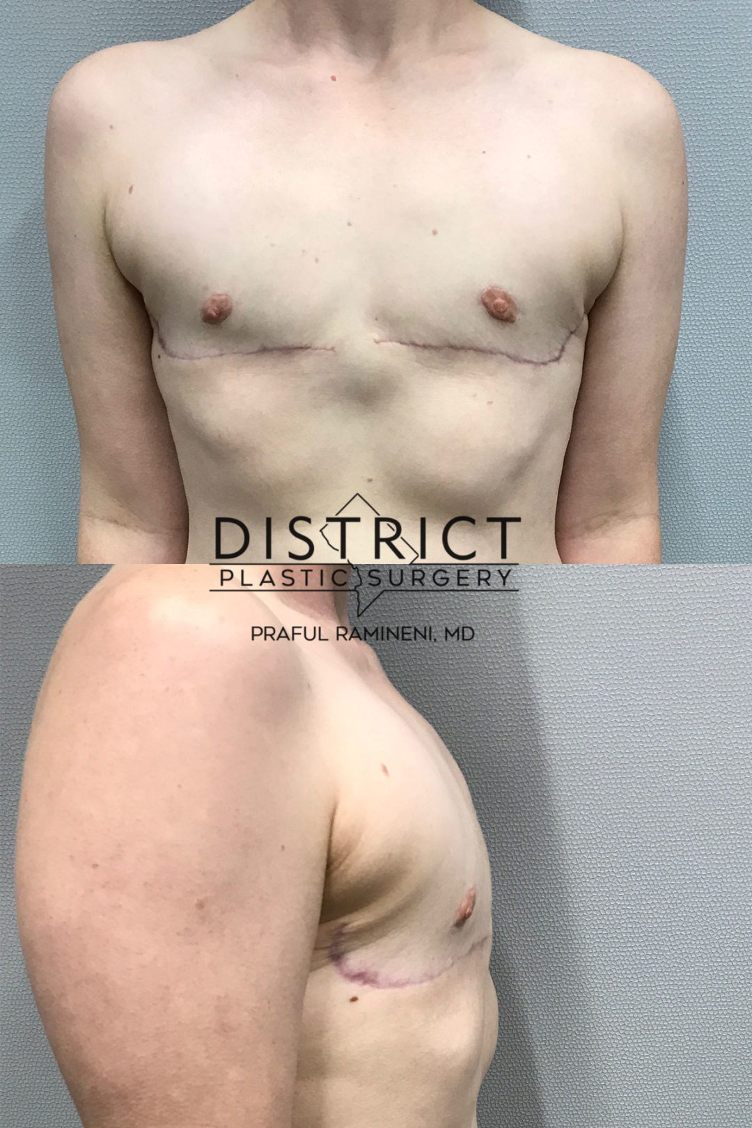 bilateral mastectomy before and after