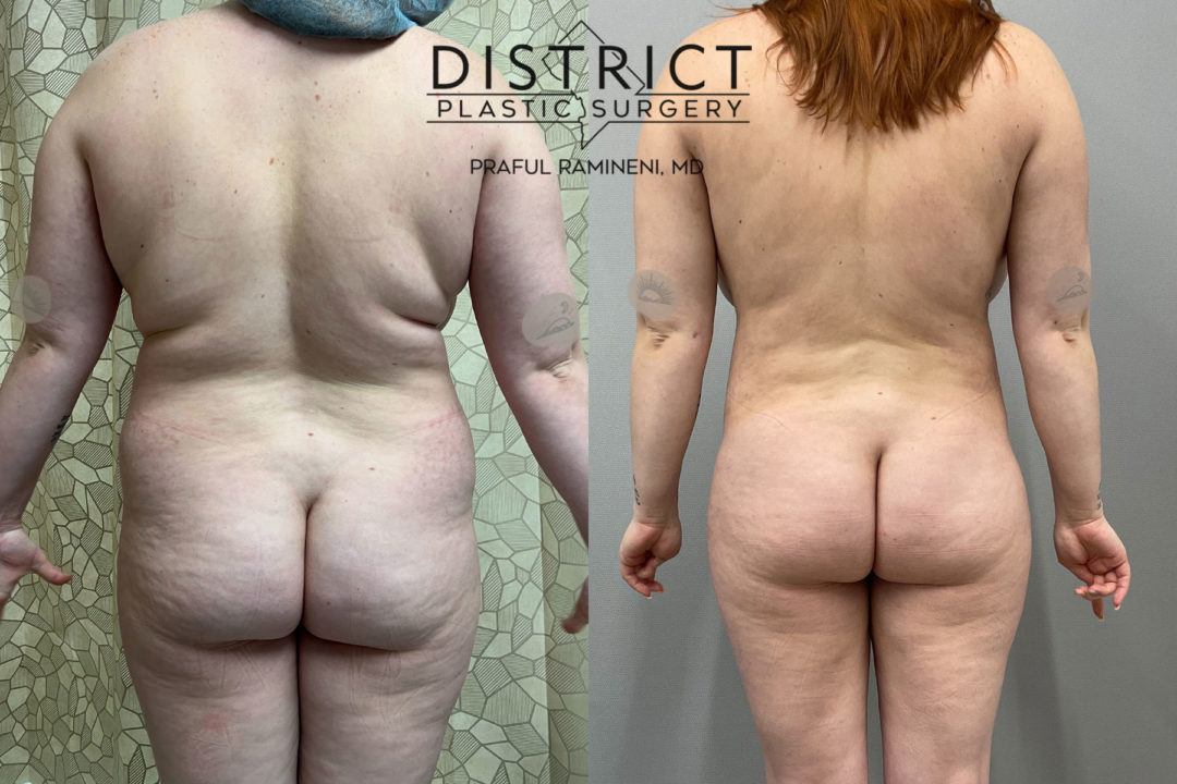 liposuction before and after