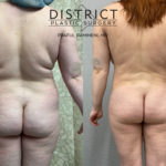 liposuction before and after