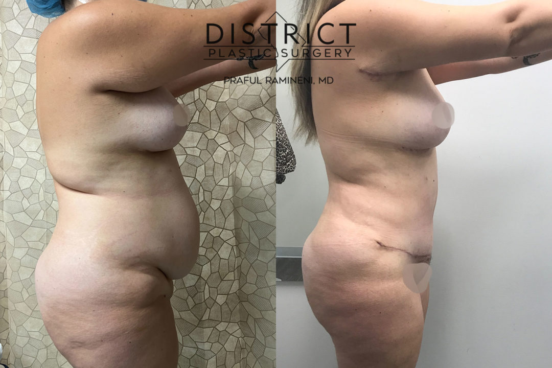 abdominoplasty before and after