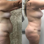 abdominoplasty before and after