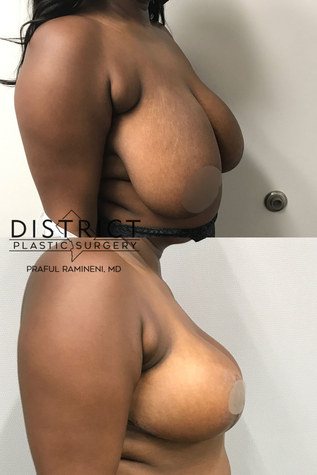 breast reduction before and after