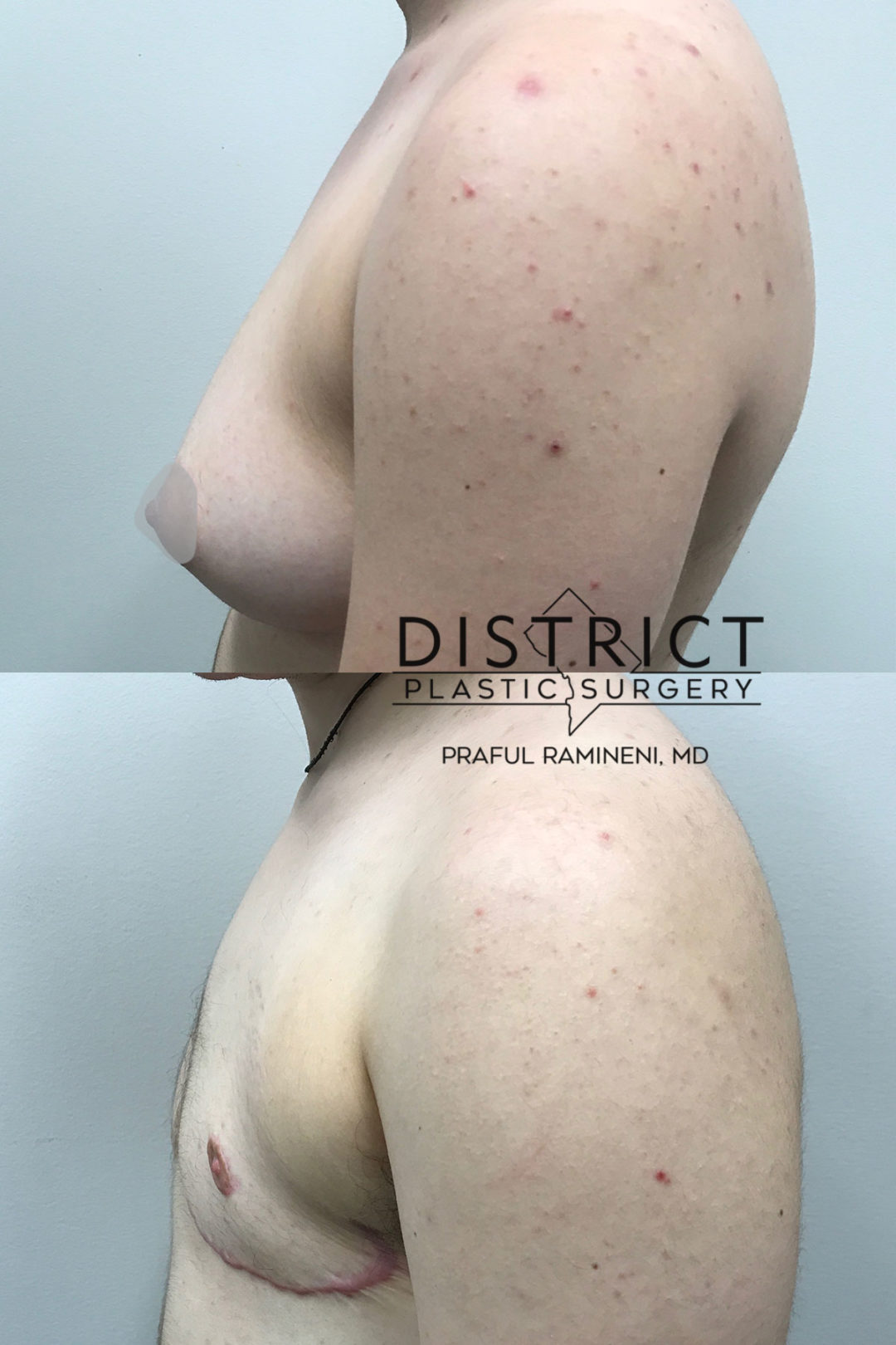 bilateral mastectomy before and after