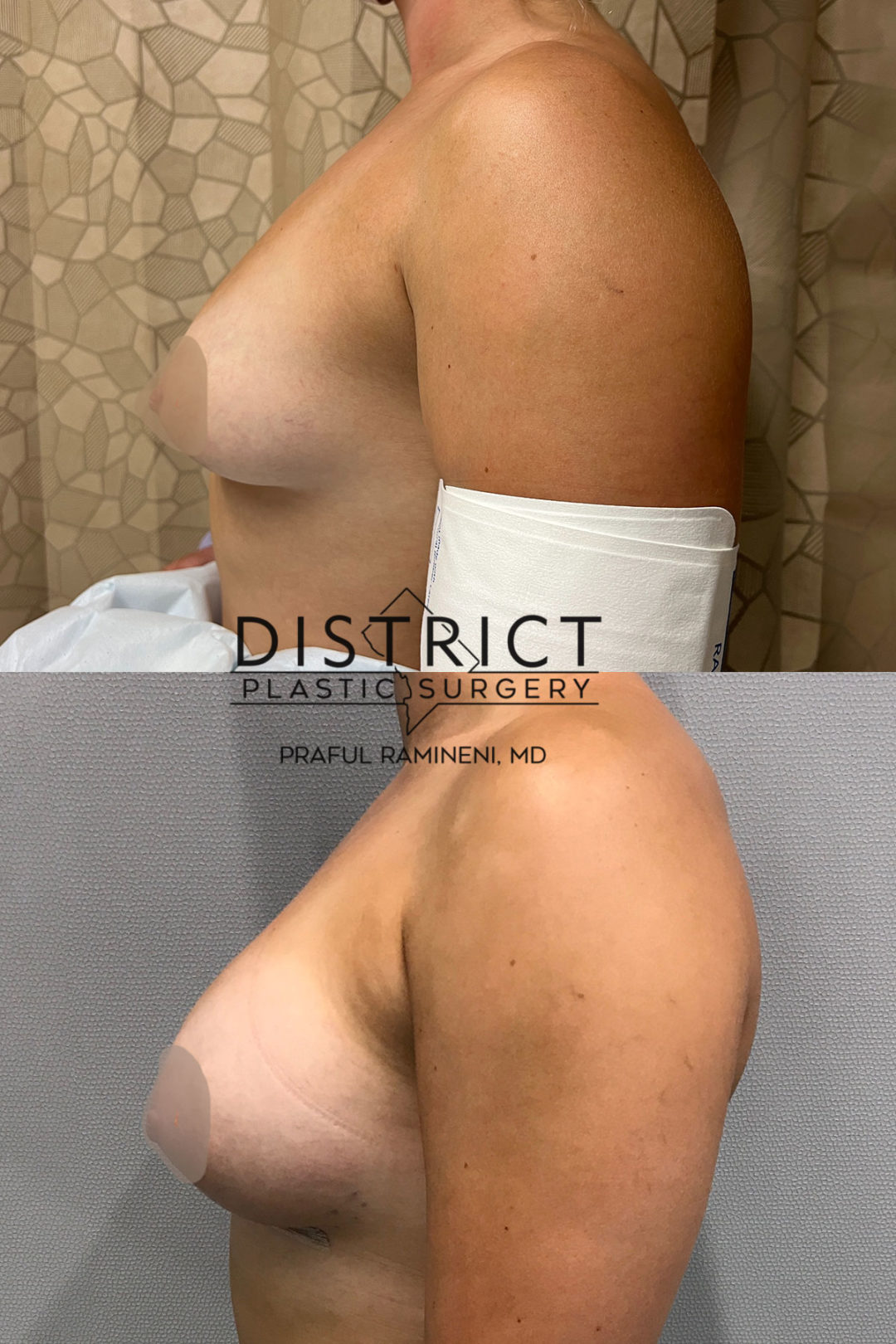 breast augmentation before and after