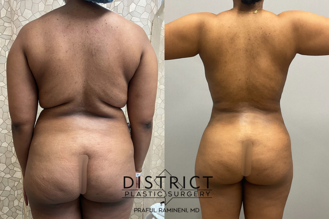 liposuction before and after