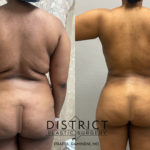liposuction before and after