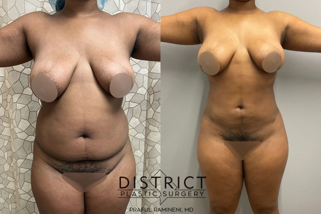liposuction before and after