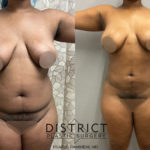 liposuction before and after
