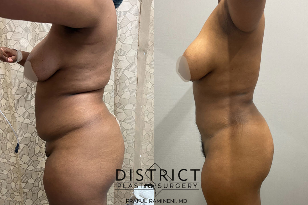 liposuction before and after