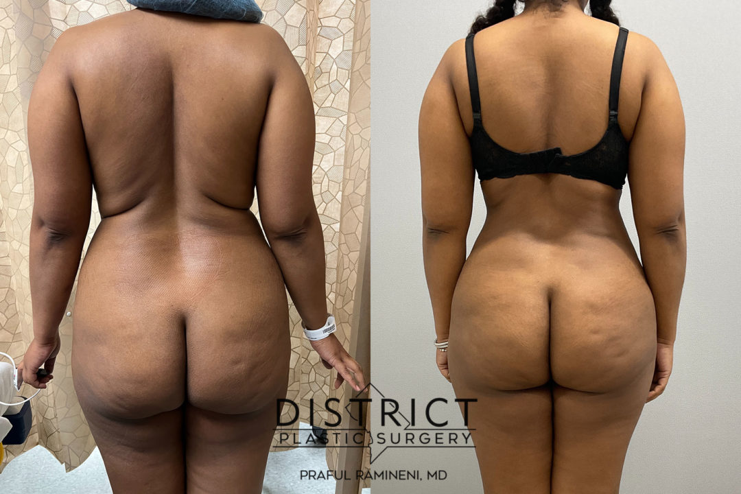 abdominoplasty before and after