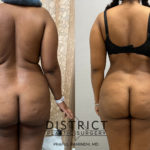 abdominoplasty before and after