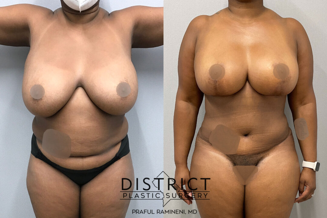 Abdominoplasty Before and After Photo by District Plastic Surgery in Washington, DC