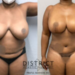 Abdominoplasty Before and After Photo by District Plastic Surgery in Washington, DC