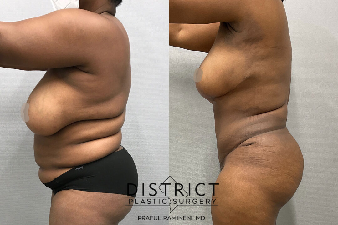 Abdominoplasty Before and After Photo by District Plastic Surgery in Washington, DC