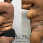 Abdominoplasty Before and After Photo by District Plastic Surgery in Washington, DC