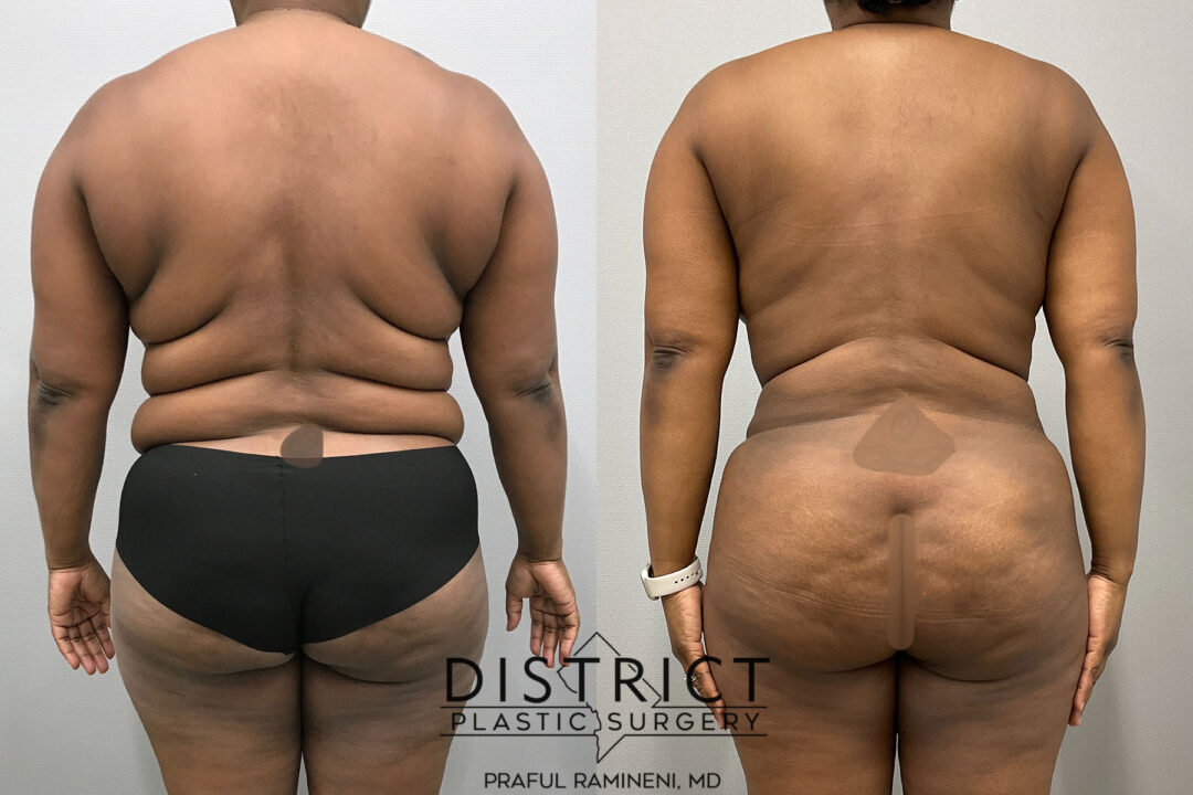 Abdominoplasty Before and After Photo by District Plastic Surgery in Washington, DC