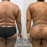 Abdominoplasty Before and After Photo by District Plastic Surgery in Washington, DC