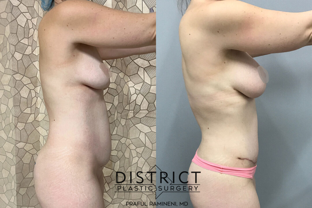Abdominoplasty Before and After Photo by District Plastic Surgery in Washington, DC