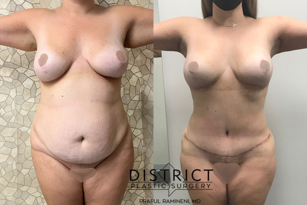 Abdominoplasty Before and After Photo by District Plastic Surgery in Washington, DC