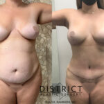 Abdominoplasty Before and After Photo by District Plastic Surgery in Washington, DC