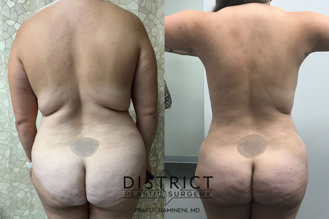 Abdominoplasty Before and After Photo by District Plastic Surgery in Washington, DC