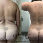 Abdominoplasty Before and After Photo by District Plastic Surgery in Washington, DC