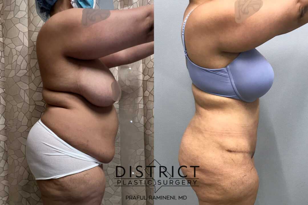 Abdominoplasty Before and After Photo by District Plastic Surgery in Washington, DC