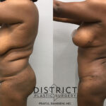 Abdominoplasty Before and After Photo by District Plastic Surgery in Washington, DC