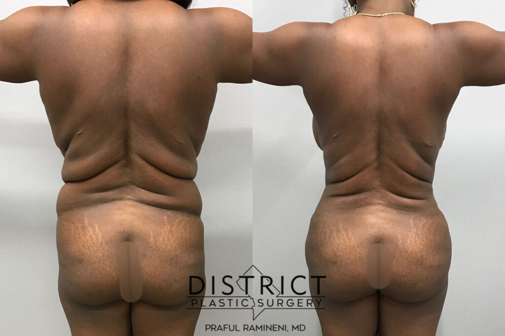 Abdominoplasty Before and After Photo by District Plastic Surgery in Washington, DC Abdominoplasty Before and After Photo by District Plastic Surgery in Washington, DC