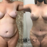 Arm Lift Before and After Photo by District Plastic Surgery in Washington, DC