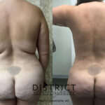 Arm Lift Before and After Photo by District Plastic Surgery in Washington, DC