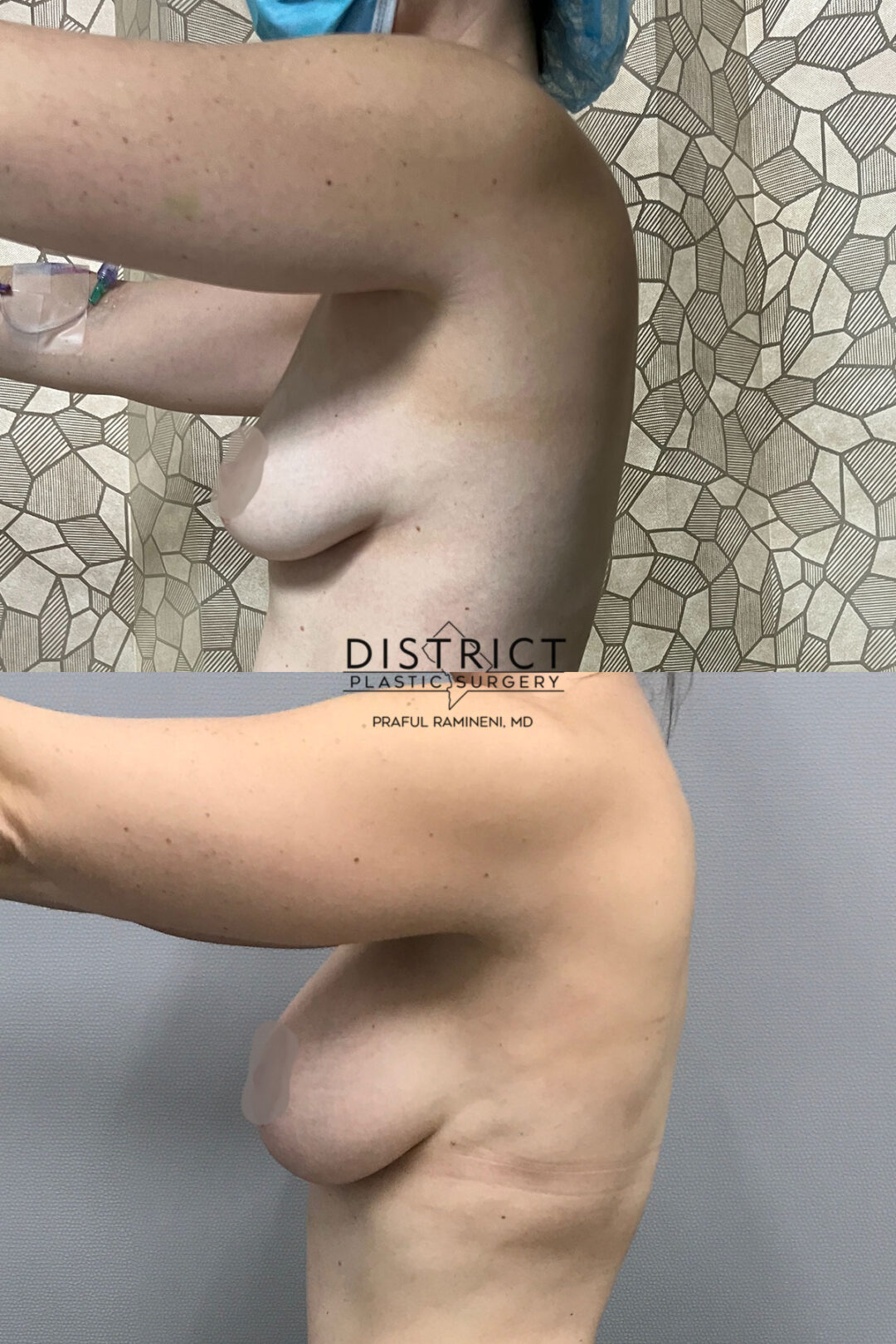 Breast Augmentation Before and After Photo by District Plastic Surgery in Washington, DC