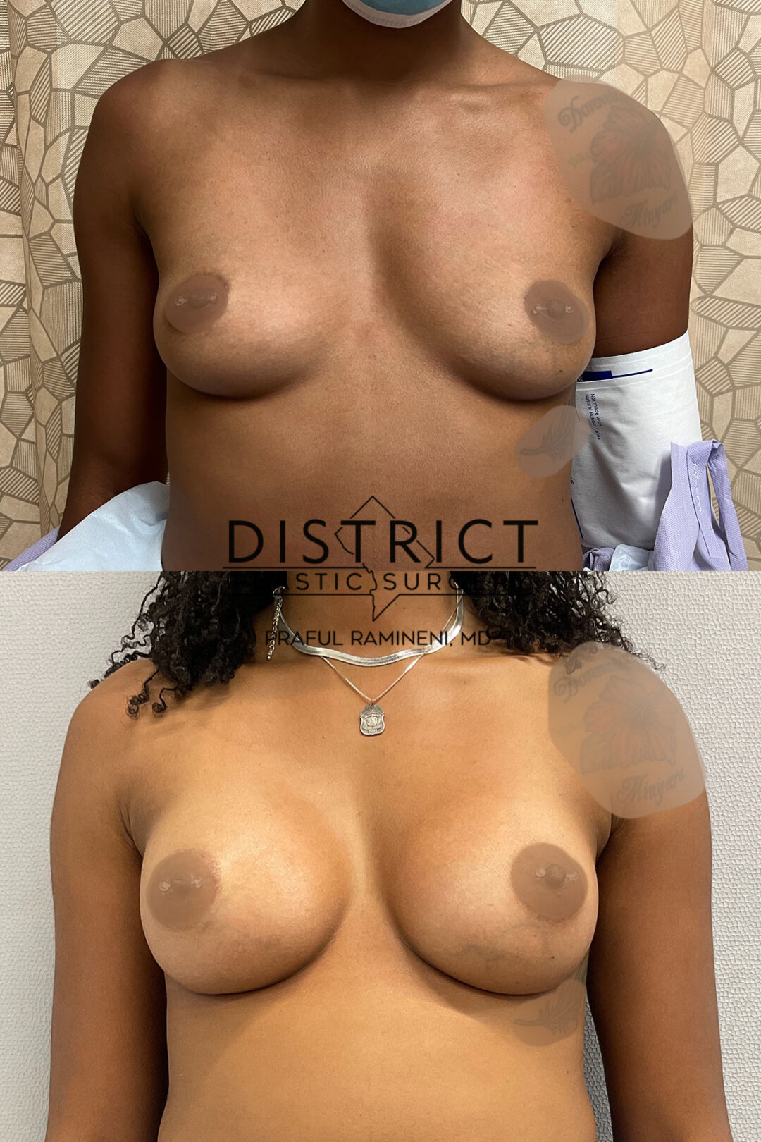 Breast Augmentation Before and After Photo by District Plastic Surgery in Washington, DC