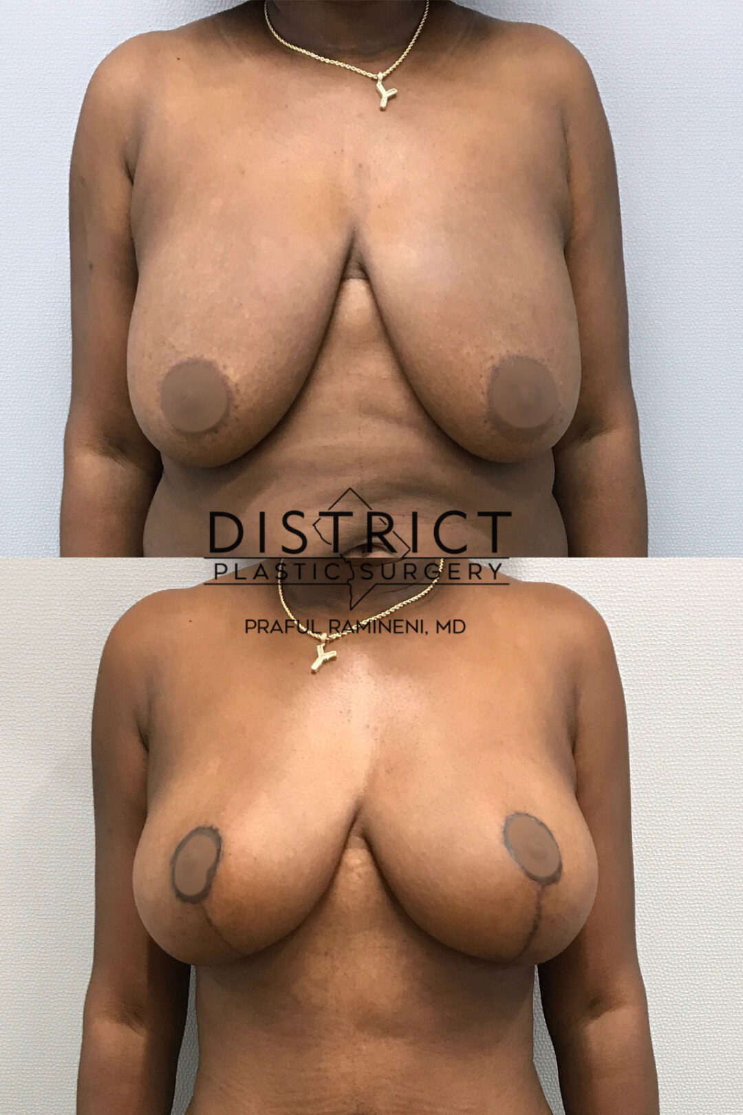Breast Lift Before and After Photo by District Plastic Surgery in Washington, DC
