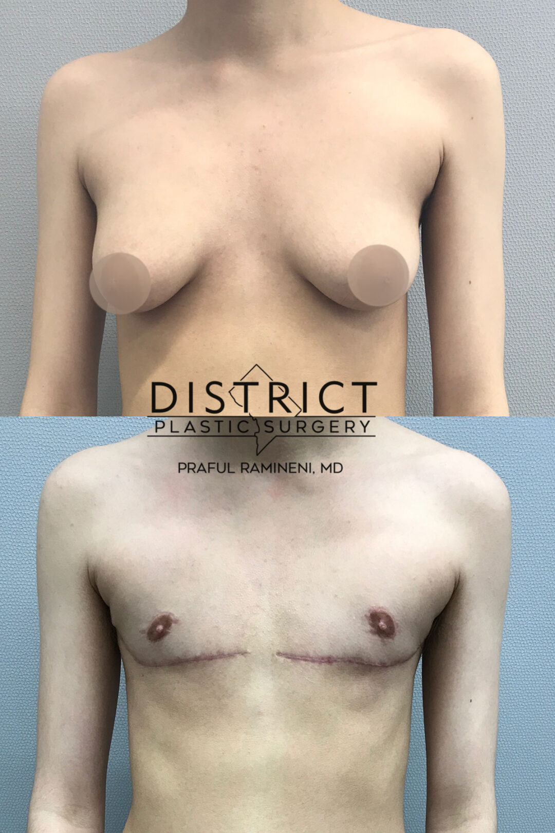 Double Incision Mastectomy Before and After Photo by District Plastic Surgery in Washington, DC